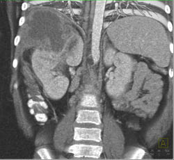 Renal Abscess - CTisus CT Scan