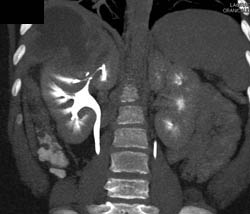 Renal Abscess - CTisus CT Scan