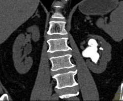 staghorn calculus ct