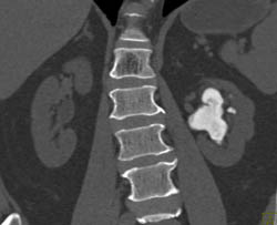 kidney stone staghorn calculus