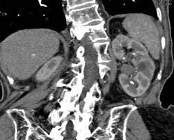 Transitional Cell Carcinoma - CTisus CT Scan