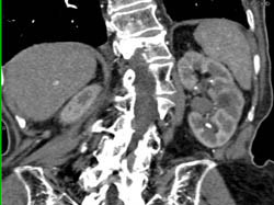 Transitional Cell Carcinoma - CTisus CT Scan