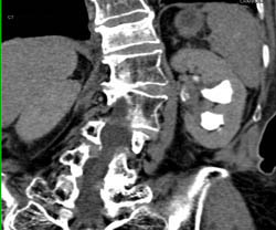 Transitional Cell Carcinoma - CTisus CT Scan