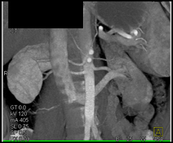 Multiple Renal Arteries - CTisus CT Scan