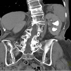 Transitional Cell Carcinoma - CTisus CT Scan