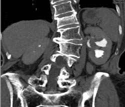 Transitional Cell Carcinoma - CTisus CT Scan