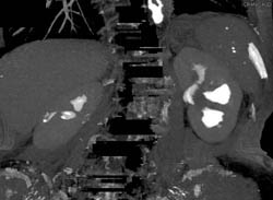 Transitional Cell Carcinoma - CTisus CT Scan