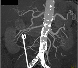 Post- Radiofrequency Ablation (RFA) Changes in Left Kidney - CTisus CT Scan