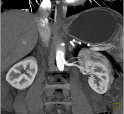 Prehilar Branching of Renal Artery on the Left - CTisus CT Scan