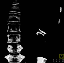 Renal Cell Carcinoma With Calcification - CTisus CT Scan