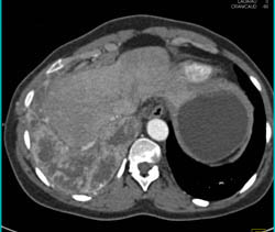 Lung and Pleural Metastases From Renal Cell Carcinoma - CTisus CT Scan