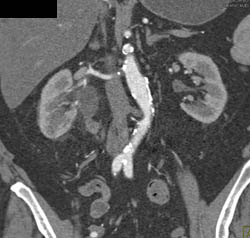 Transitional Cell Cancer (TCC) of Right Proximal Ureter - CTisus CT Scan