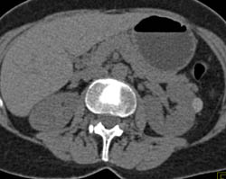 High Density Renal Cyst - CTisus CT Scan