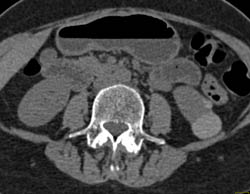 High Density Renal Cyst - CTisus CT Scan