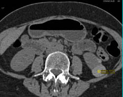 High Density Renal Cyst - CTisus CT Scan