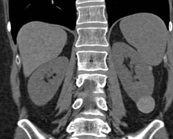 High Density Renal Cyst - CTisus CT Scan