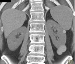 High Density Renal Cyst - CTisus CT Scan