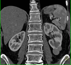 High Density Renal Cysts- See Full Sequence of Images - CTisus CT Scan