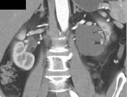 Left Ureteropelvic Junction (UPJ) With Dilated Pelvis and Calyces - CTisus CT Scan