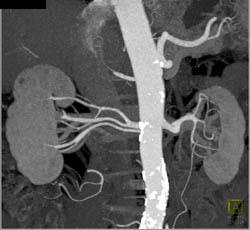 2 Right Renal Arteries With Prehilar Branching of the Upper Artery With MIP/VRT and Editing Images - CTisus CT Scan