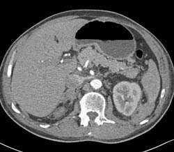 Left Perirenal Bleed - CTisus CT Scan