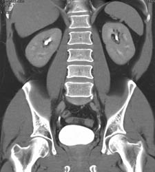 Normal CT Urogram- See Full Sequence - CTisus CT Scan