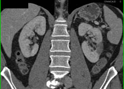 Renal Infarct - CTisus CT Scan