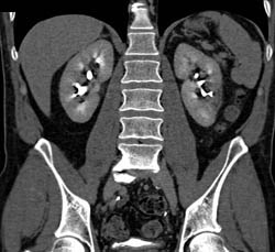 Renal Infarct - CTisus CT Scan