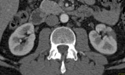 Renal Infarct - CTisus CT Scan