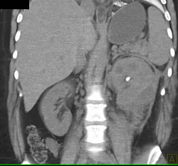 Perirenal Hematoma With Delayed Left Renal Function - CTisus CT Scan