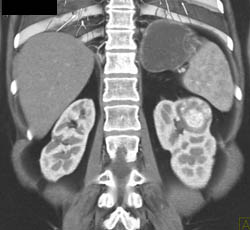 Vascular Renal Cell Carcinoma - CTisus CT Scan