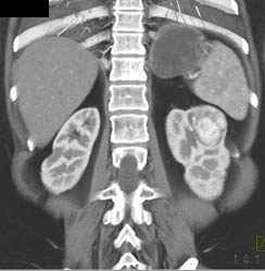 Vascular Renal Cell Carcinoma - CTisus CT Scan