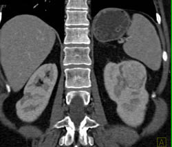 Vascular Renal Cell Carcinoma - CTisus CT Scan