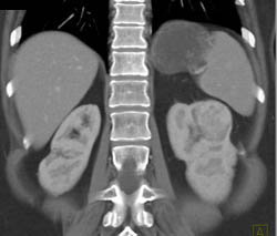 Vascular Renal Cell Carcinoma - CTisus CT Scan