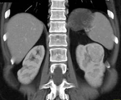 Vascular Renal Cell Carcinoma - CTisus CT Scan