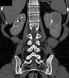 Vascular Renal Cell Carcinoma - CTisus CT Scan