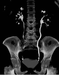 CT Urogram With Transitional Cell Cancer (TCC) Lower Pole on Left - CTisus CT Scan