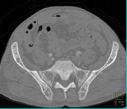 Renal Osteodystrophy Due to End Stage Renal Disease (ESRD) With Cystic Kidneys- See Full Sequence - CTisus CT Scan