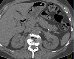 Transitional Cell Carcinoma Left Kidney - CTisus CT Scan