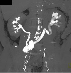 Ileal Loop With CT Cystogram - CTisus CT Scan