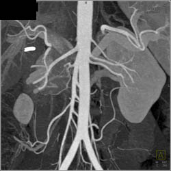 3 Left Renal Arteries in A Potential Renal Donor - CTisus CT Scan