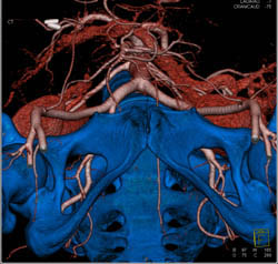 Pelvic Arteries Below Bifurcation - CTisus CT Scan