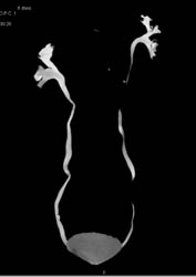 Ct Urogram Without Mass - CTisus CT Scan