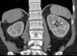 Medullary Calcinosis - CTisus CT Scan