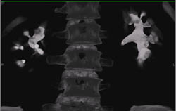 Ct Urogram - CTisus CT Scan