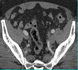 Subtle Transitional Cell Carcinoma of the Distal Left Ureter - CTisus CT Scan