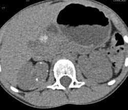 Calcifications in Right Kidney - CTisus CT Scan