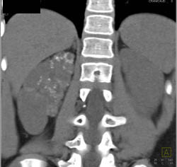 Cystic Changes in Right Kidney With Faint Calcifications and Scarring- See Full Sequence - CTisus CT Scan