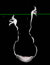 Ct Urogram - CTisus CT Scan