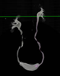 Ct Urogram - CTisus CT Scan